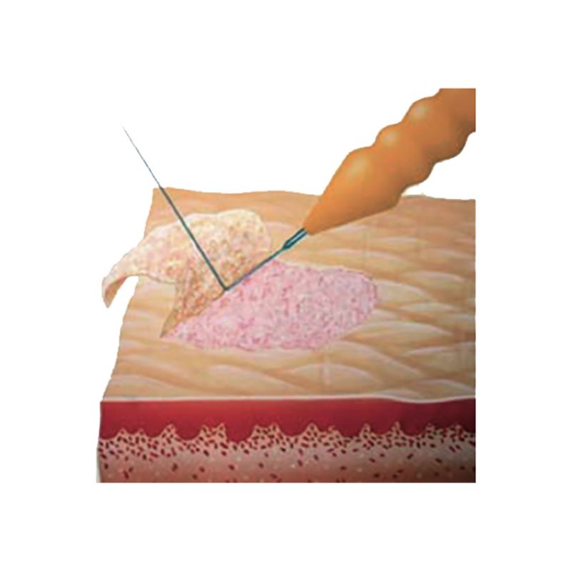 TIMED® Plasma Technology – Image 2